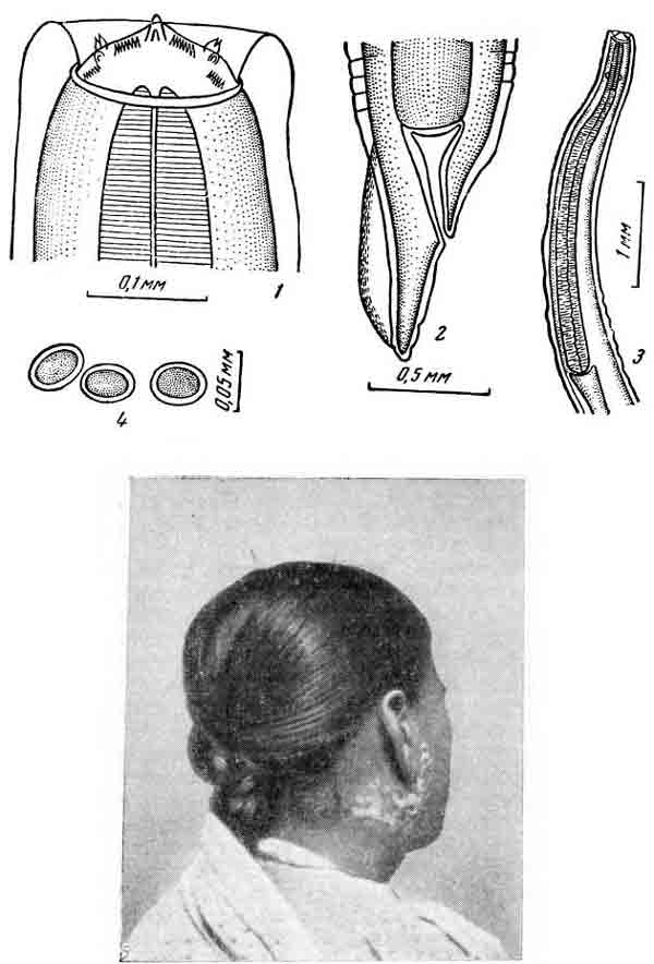 Physaloptera sp. Singh et Rao, 1954 по Сингху и Rao, (1954)